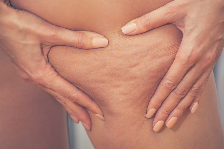 Hormones, genetics, and lifestyle can all play apart in causing cellulite