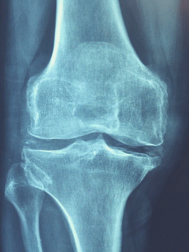 Joint Fluid Are Your Low Levels Causing Joint Pain 2